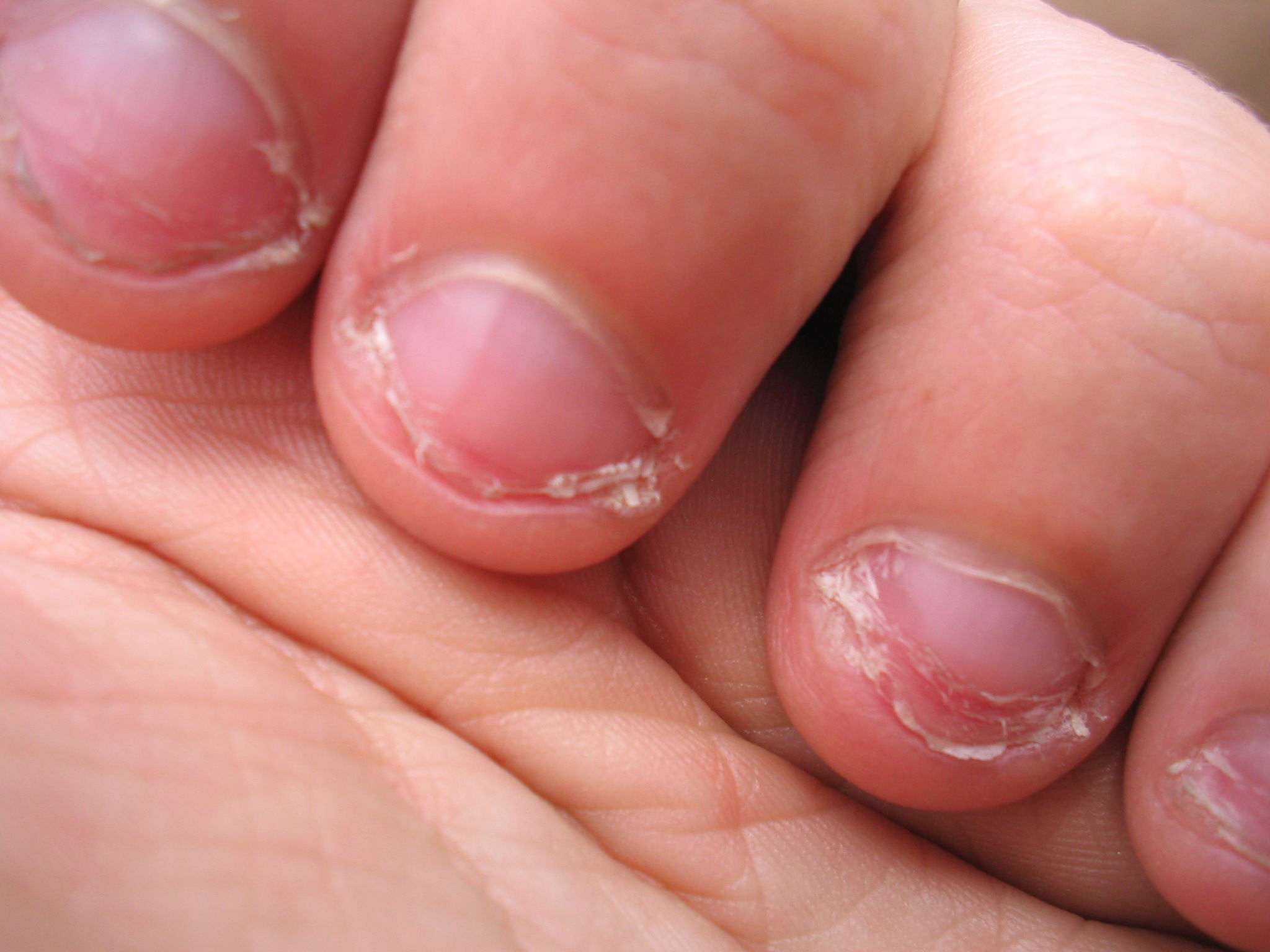 Why Do People Bite Their Nails (& 5 Ways to Stop Nail Biting)