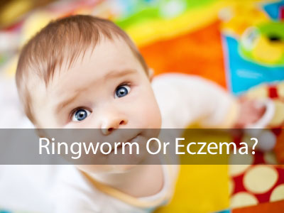 ringworm or eczema